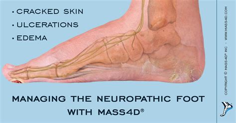 How To Manage the Neuropathic Foot with MASS4D® - MASS4D® Foot Orthotics