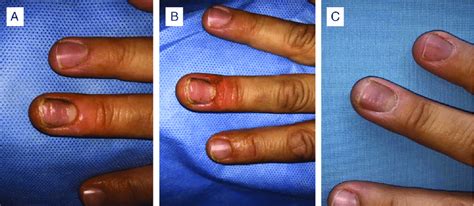 A) Chronic paronychia. The patient had been prescribed several oral and... | Download Scientific ...