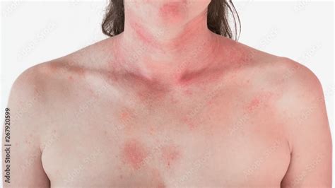 Allergic skin reaction on the female neck and face - red rash Stock ...