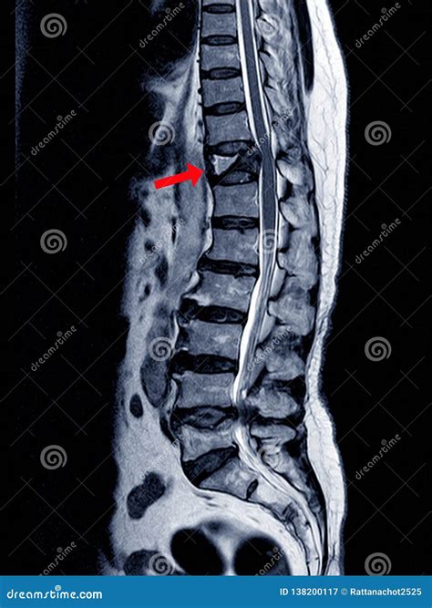 Lumbar Fracture Stock Photography | CartoonDealer.com #43419806