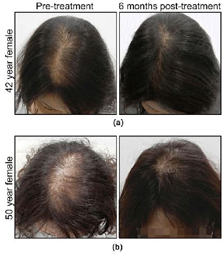 Representative photographs of hair re-growth, before and after ...