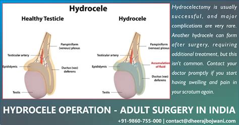 Hydrocele surgery in India - Get Better and More Wide-Ranging Care