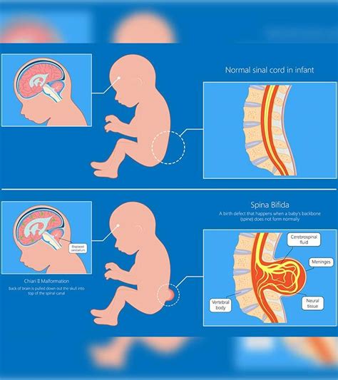 Spina Bifida In Babies: Types, Symptoms, Diagnosis And Treatment - Baby ...