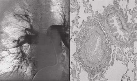 Left: Pulmonary angiogram of a patient having acute on chronic... | Download Scientific Diagram