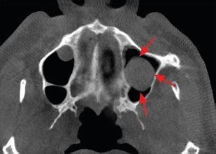 What Is A Sinus Rentention Cyst A Maxillary Sinus Retention Cyst Do I ...