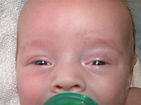 Walter's Hydrocephalus Education blog: Primary care needs of children with hydrocephalus