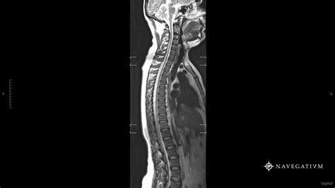 Cervical Thoracic Spine MRi by Navegatium App #Radiology #MRi Thoracic ...