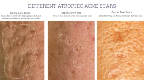 Best Acne and Acne Scars treatment anyone? - Page 45 - www.hardwarezone.com.sg