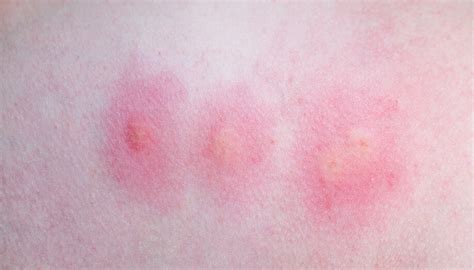 Identifying Common Insect Bites and Stings | Sentinel Blog