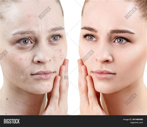 Woman Acne Before Image & Photo (Free Trial) | Bigstock