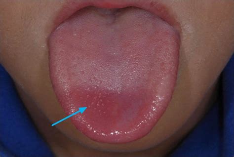 Transient lingual papillitis or lie bumps causes and lie bumps treatment