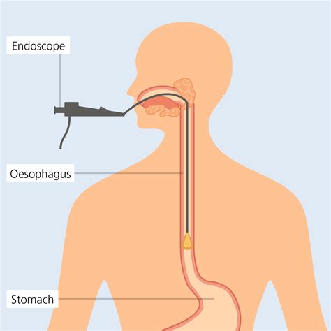 Dilation - Eosinophilic Oesophagitis