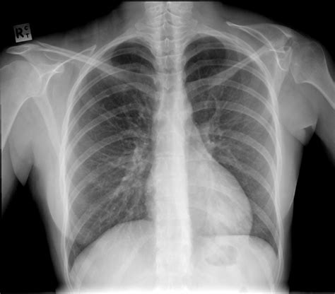 Sprengel deformity | Radiology Case | Radiopaedia.org | Radiology, X ...