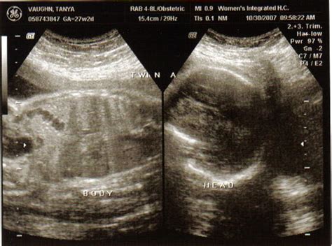 The Journey for Baby: Biophysical Profile Day (BPP)