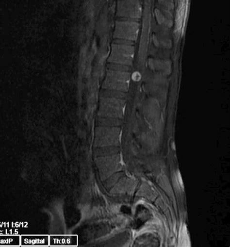 Intradural extramedullary enhancing tumor is noted at the 1st lumbar... | Download Scientific ...