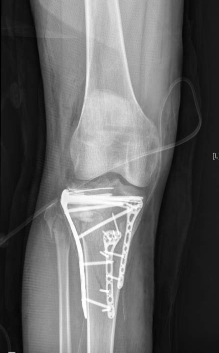 Tibial plateau fracture surgery - wikidoc