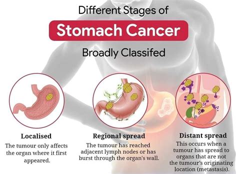 Stomach Cancer Treatment & Surgery | Dr. Nikhil Agrawal | Best GI ...