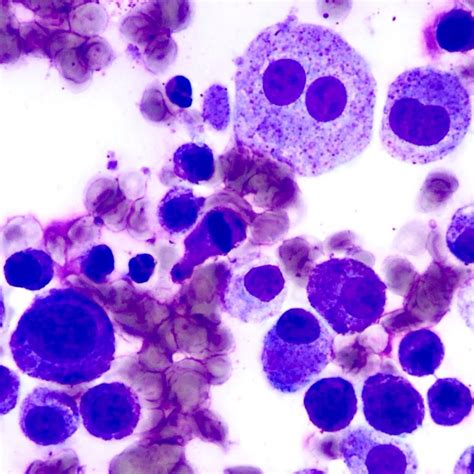 Poorly differentiated mast cell tumor FNA cytology from a dog. | Mast cell tumor dogs ...