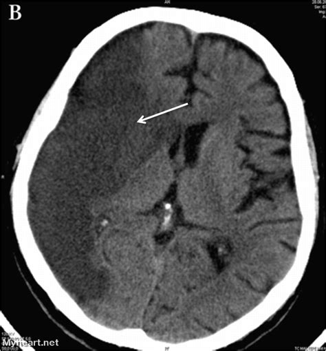 Stroke: What You Need to Know • MyHeart