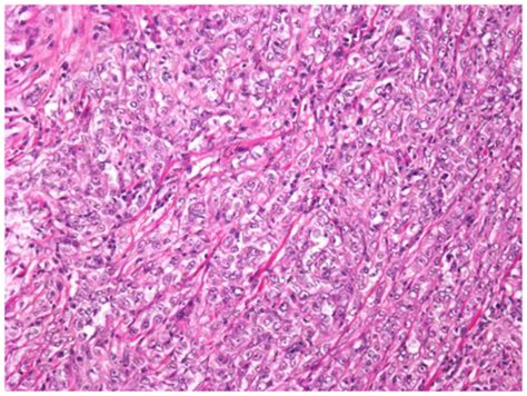 Mucin‑poor and aggressive mucinous tubular and spindle cell carcinoma of the kidney: Two case ...