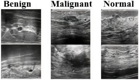 Malignant Breast Cancer On Ultrasound