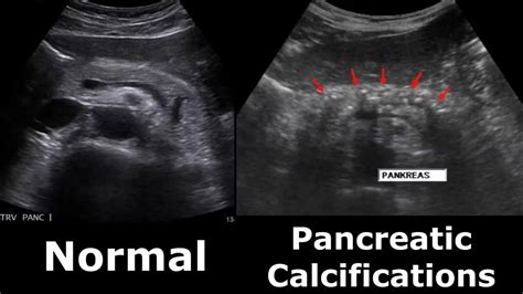 Pancreas Ultrasound Normal Vs Abnormal Appearances Comparison Pancreas Pathologies On Ultrasound ...