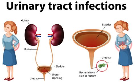 Urinary Tract Infection Discharge