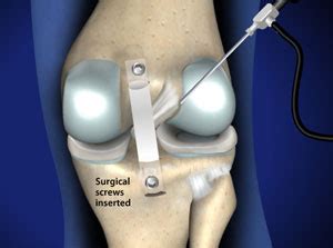 Posterior Cruciate Ligament (PCL) Reconstruction in Plano, Frisco, McKinney and Allen