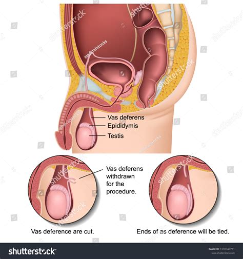 46 Castration Human Male Royalty-Free Photos and Stock Images ...