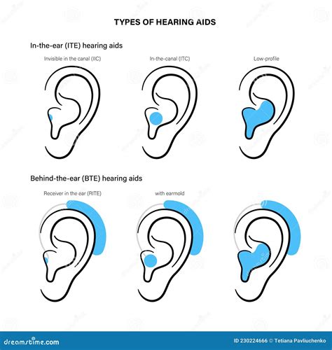 Hearing aids types stock vector. Illustration of audio - 230224666