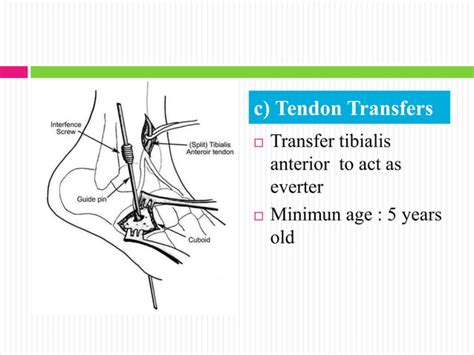 Mellss yr5 ortho treatment of congenital talipes equino varus (ctev)