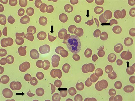 Microangiopathic hemolytic anemia - Cancer Therapy Advisor