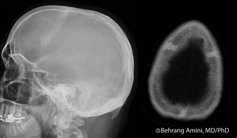 Roentgen Ray Reader: Sutural Hyperostosis