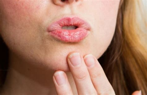 Don’t Ignore These Dry Lips And Mouth Symptoms!