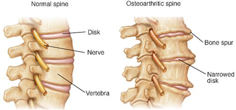 Osteoarthritis - Causes, Symptoms, Diagnosis, Prognosis & Treatment