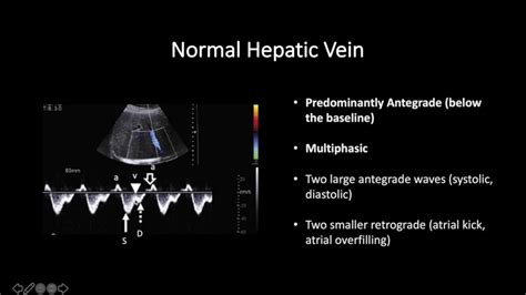 Doppler Ultrasound Part 2 - Spectral Waveforms from Head to Toe (Normal and Abnormal) - YouTube