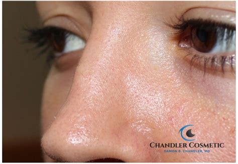 Mole on Nose | Nose Mole Removal Near Me - Dr. Chandler