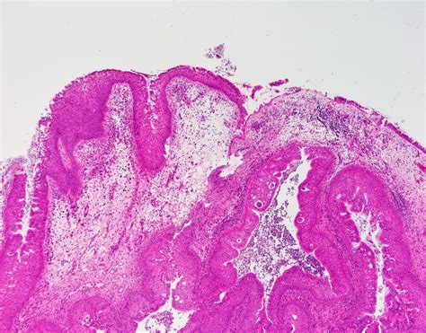 Inverted Papilloma | Global Pathology Teaching and Education Program