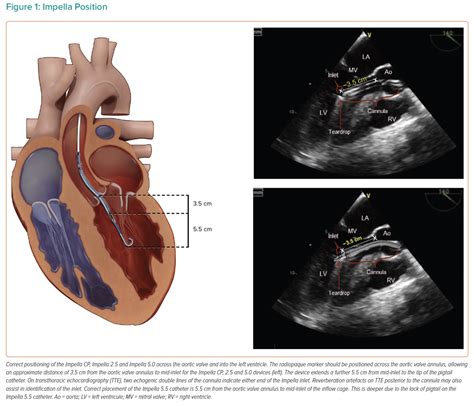 Impella Devices 101 - REBEL EM - Emergency Medicine Blog