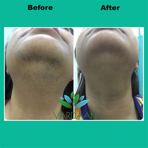 Laser Hair Removal Clinic in Delhi, Full Body Laser Hair Removal Cost ...