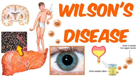 Wilson's Disease! - YouTube