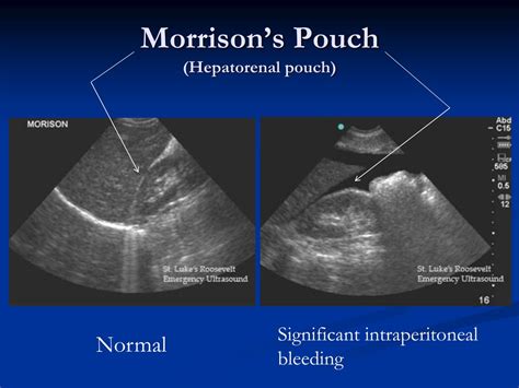 PPT - Prehospital Ultrasound PowerPoint Presentation, free download - ID:9212767