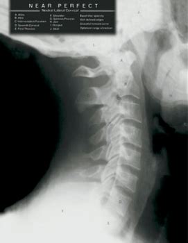 Chronic Neck Pain or Stiffness? Get Your Neck Curvature checked - Ask ...