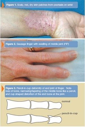 Psoriatic Arthritis Treatment White Plains, Brooklyn, New York