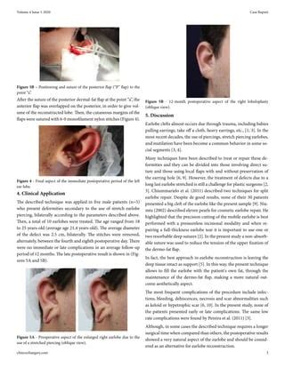 Increase Lobuloplasty in the Treatment of Deformities Secondary to the Use of Stretched Piercing ...