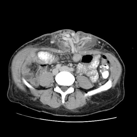 CT/MRI Clinicals: Caput Medusae