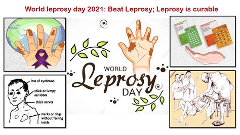 The Family physician : World leprosy day 2021: Beat Leprosy; Leprosy is ...