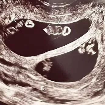 Quadruplets Ultrasound