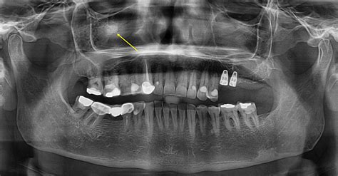 Cureus | Maxillary Antroliths: A Digital Panoramic-based Study