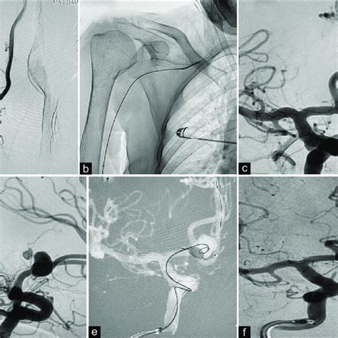 Rupture ACOM aneurysm (a) right radial run shows brachioradialis ...